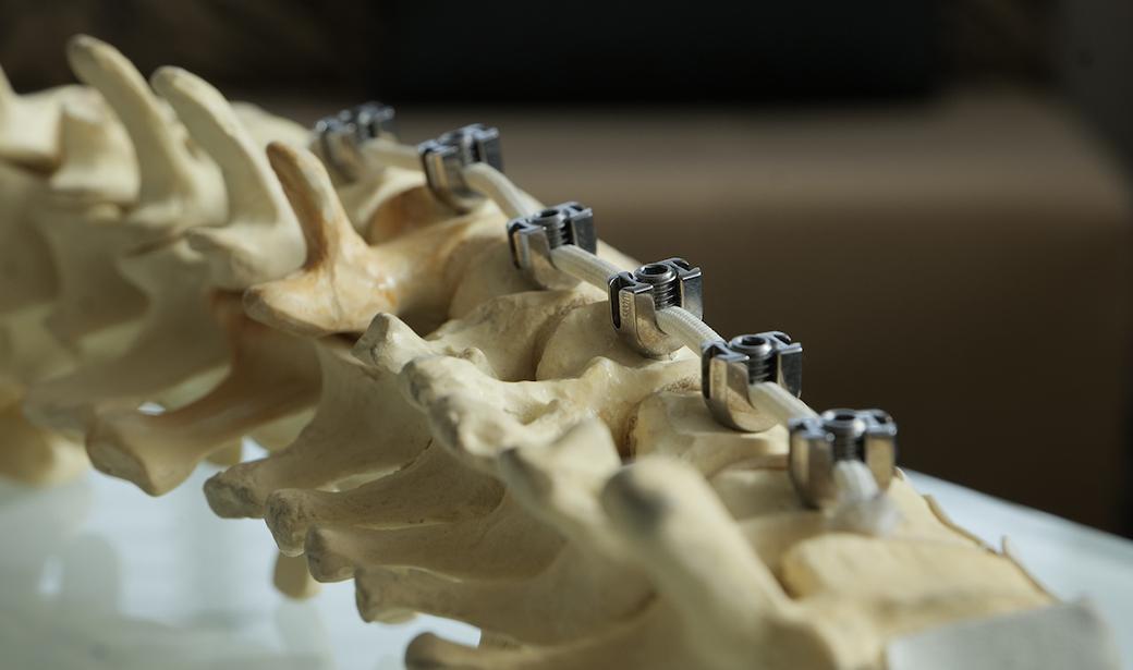 Vertebral Body Tethering example