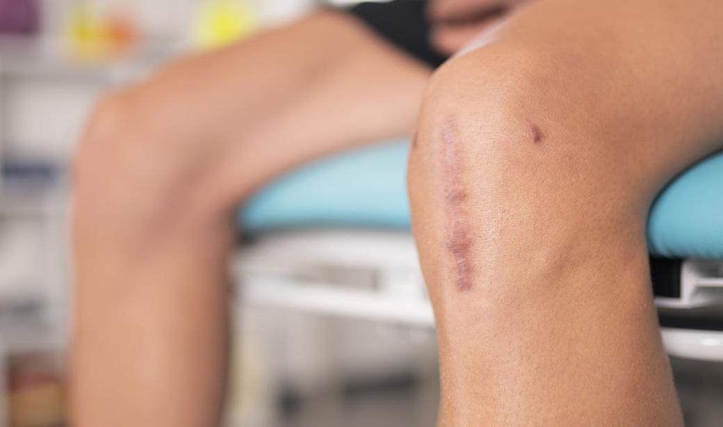 Photo of a knee with stitches.